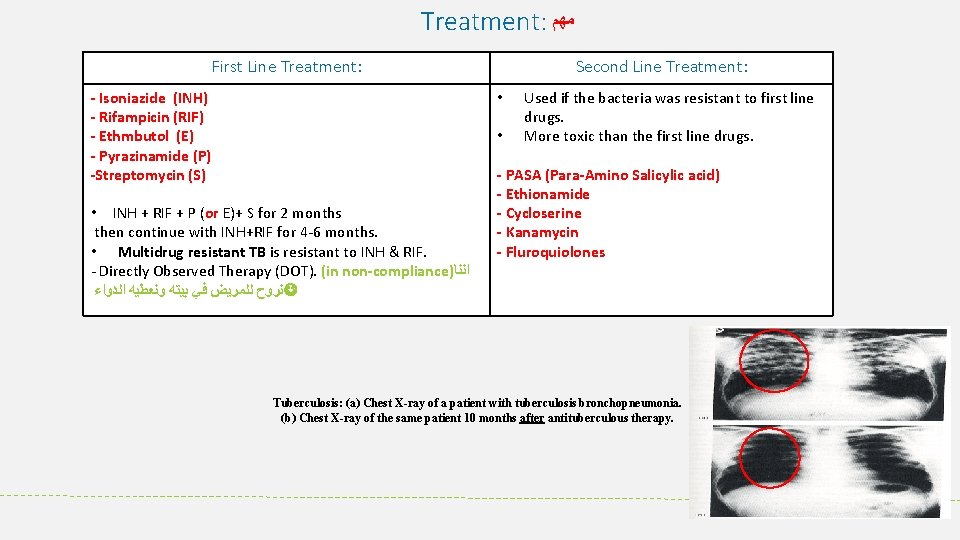 Treatment: ﻣﻬﻢ First Line Treatment: Isoniazide (INH) Rifampicin (RIF) Ethmbutol (E) Pyrazinamide (P) Streptomycin