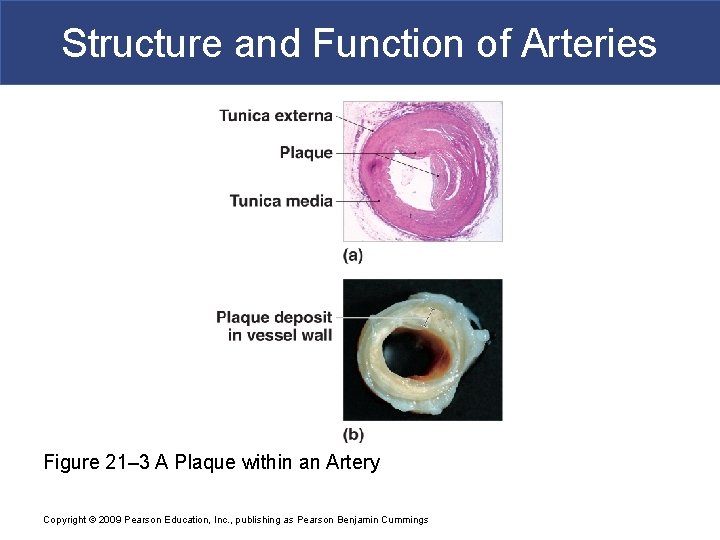 Structure and Function of Arteries Figure 21– 3 A Plaque within an Artery Copyright