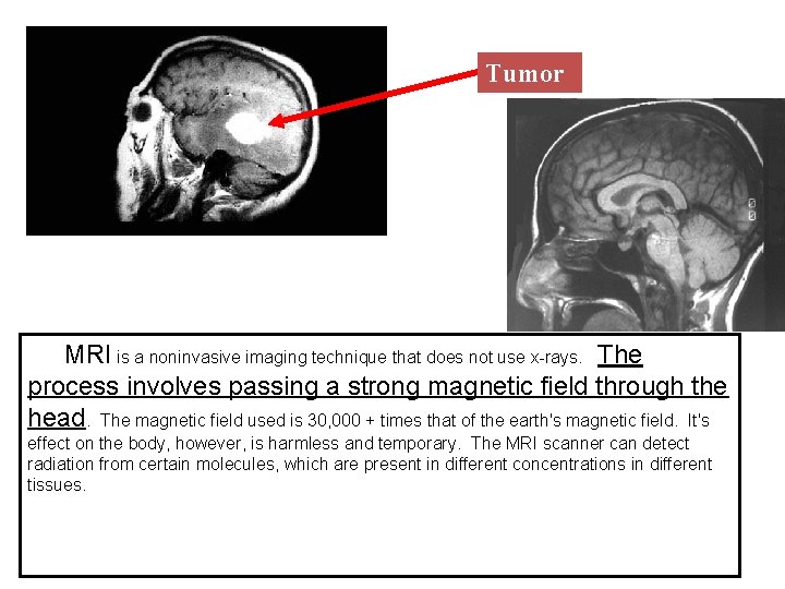 Tumor MRI is a noninvasive imaging technique that does not use x-rays. The process