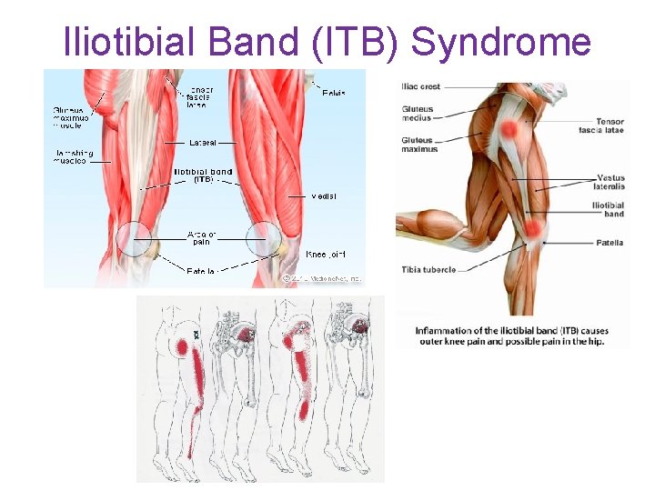Iliotibial Band (ITB) Syndrome 