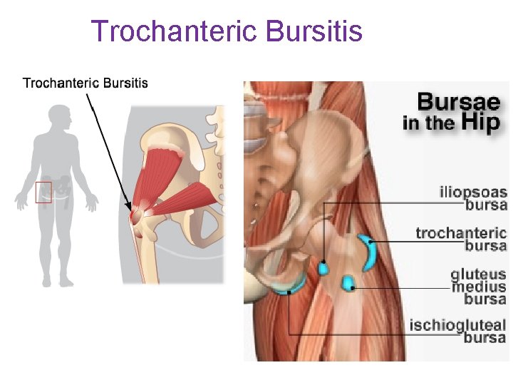 Trochanteric Bursitis 