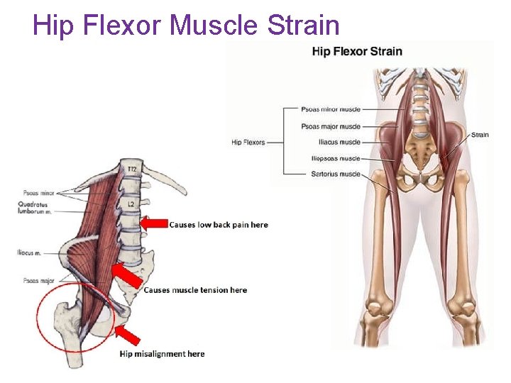 Hip Flexor Muscle Strain 