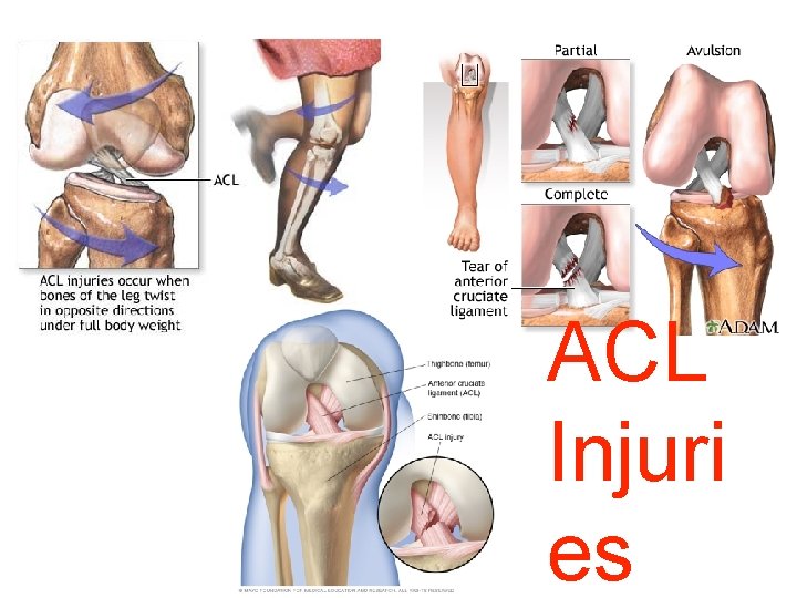 ACL Injuri es 