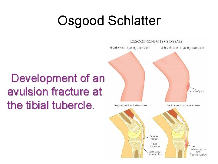 Osgood Schlatter Development of an avulsion fracture at the tibial tubercle. 