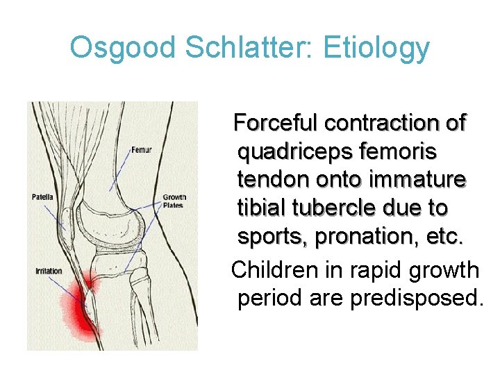 Osgood Schlatter: Etiology Forceful contraction of quadriceps femoris tendon onto immature tibial tubercle due
