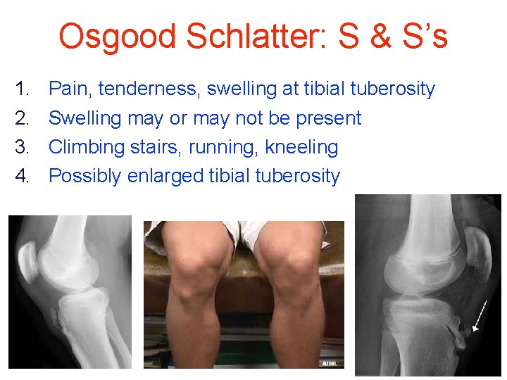 Osgood Schlatter: S & S’s 1. 2. 3. 4. Pain, tenderness, swelling at tibial