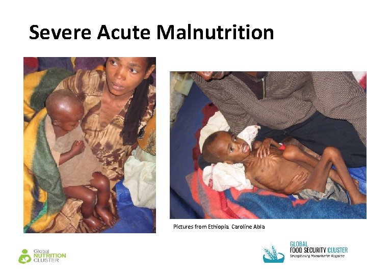 Severe Acute Malnutrition Pictures from Ethiopia. Caroline Abla 