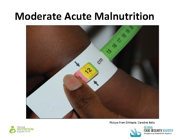 Moderate Acute Malnutrition Picture from Ethiopia. Caroline Abla 