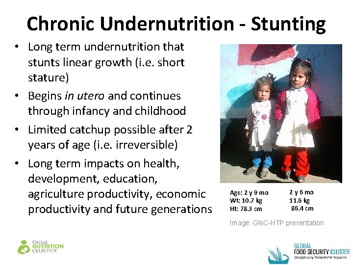 Chronic Undernutrition - Stunting • Long term undernutrition that stunts linear growth (i. e.
