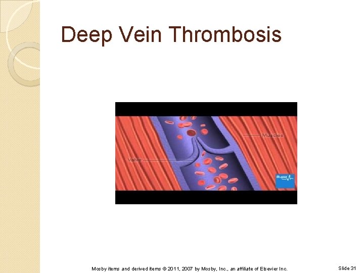 Deep Vein Thrombosis Mosby items and derived items © 2011, 2007 by Mosby, Inc.