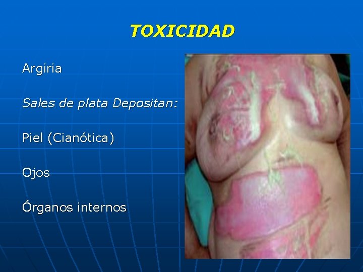 TOXICIDAD Argiria Sales de plata Depositan: Piel (Cianótica) Ojos Órganos internos 