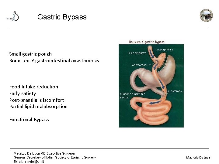 Gastric Bypass Small gastric pouch Roux –en-Y gastrointestinal anastomosis Food Intake reduction Early satiety