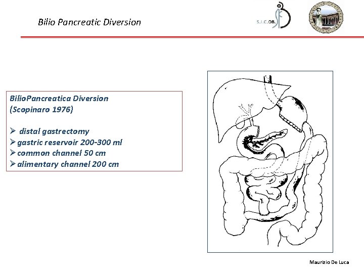 Bilio Pancreatic Diversion Bilio. Pancreatica Diversion (Scopinaro 1976) Ø distal gastrectomy Øgastric reservoir 200