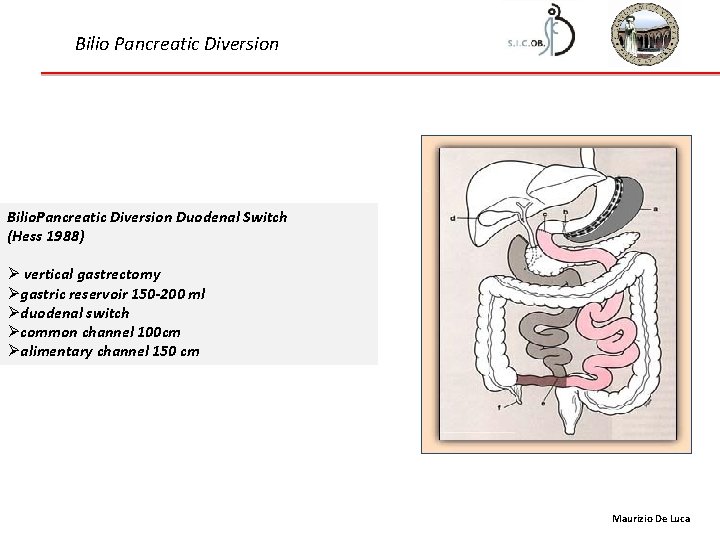 Bilio Pancreatic Diversion Bilio. Pancreatic Diversion Duodenal Switch (Hess 1988) Ø vertical gastrectomy Øgastric