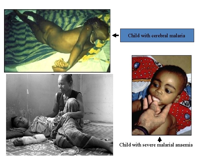 Child with cerebral malaria Child with severe malarial anaemia 
