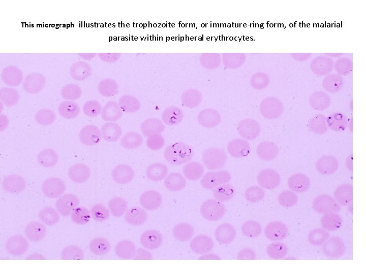 This micrograph illustrates the trophozoite form, or immature-ring form, of the malarial parasite within