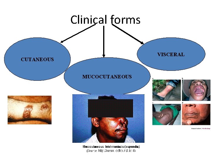 Clinical forms VISCERAL CUTANEOUS MUCOCUTANEOUS 