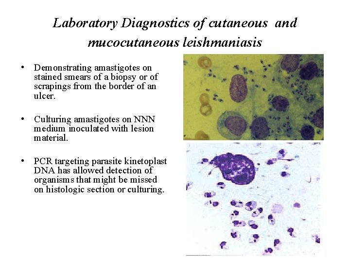 Laboratory Diagnostics of cutaneous and mucocutaneous leishmaniasis • Demonstrating amastigotes on stained smears of