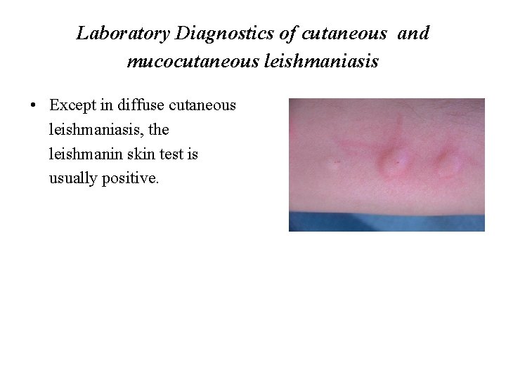 Laboratory Diagnostics of cutaneous and mucocutaneous leishmaniasis • Except in diffuse cutaneous leishmaniasis, the