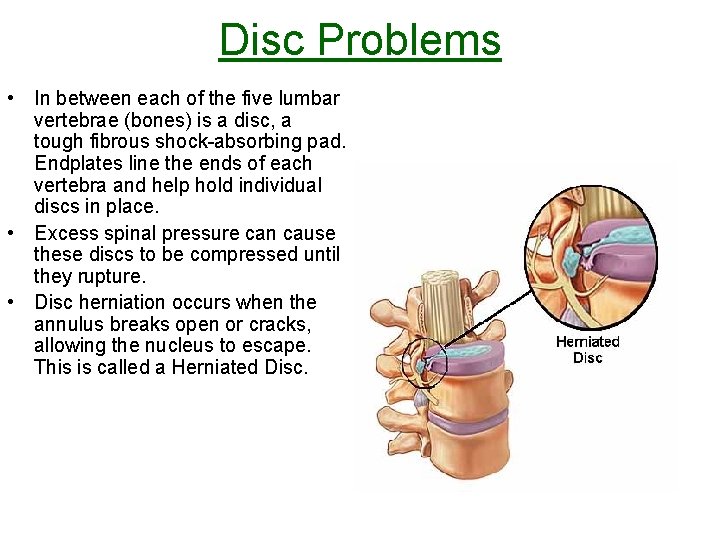 Disc Problems • In between each of the five lumbar vertebrae (bones) is a Disc Problems • In between each of the five lumbar vertebrae (bones) is a
