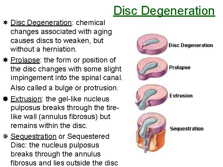 Disc Degeneration ¬ Disc Degeneration: chemical changes associated with aging causes discs to weaken,