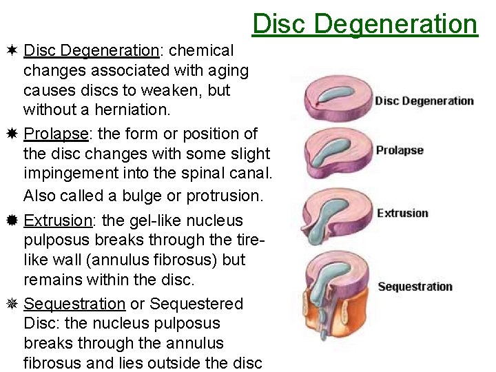 Disc Degeneration ¬ Disc Degeneration: chemical changes associated with aging causes discs to weaken, Disc Degeneration ¬ Disc Degeneration: chemical changes associated with aging causes discs to weaken,
