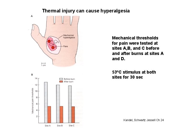 Thermal injury can cause hyperalgesia Mechanical thresholds for pain were tested at sites A,