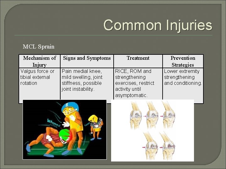 Common Injuries MCL Sprain Mechanism of Injury Valgus force or tibial external rotation Signs