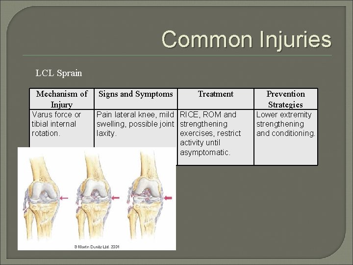 Common Injuries LCL Sprain Mechanism of Injury Varus force or tibial internal rotation. Signs