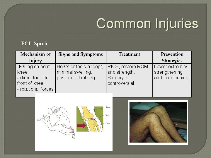 Common Injuries PCL Sprain Mechanism of Injury Signs and Symptoms -Falling on bent Hears