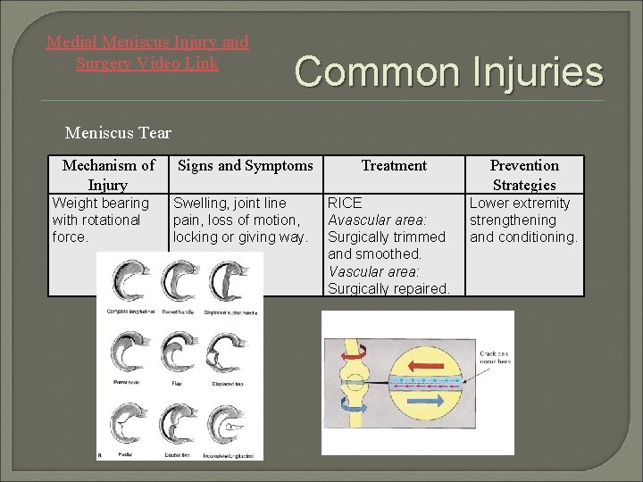 Medial Meniscus Injury and Surgery Video Link Common Injuries Meniscus Tear Mechanism of Injury