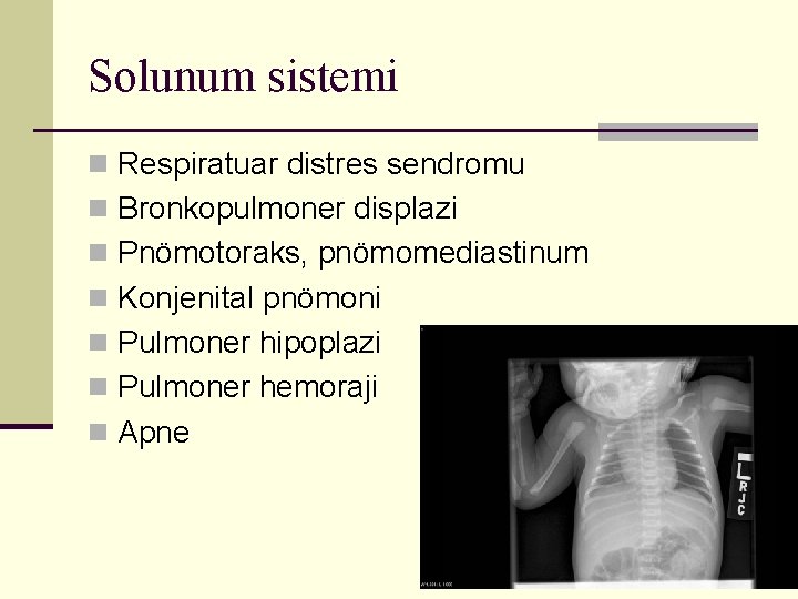 Solunum sistemi n Respiratuar distres sendromu n Bronkopulmoner displazi n Pnömotoraks, pnömomediastinum n Konjenital