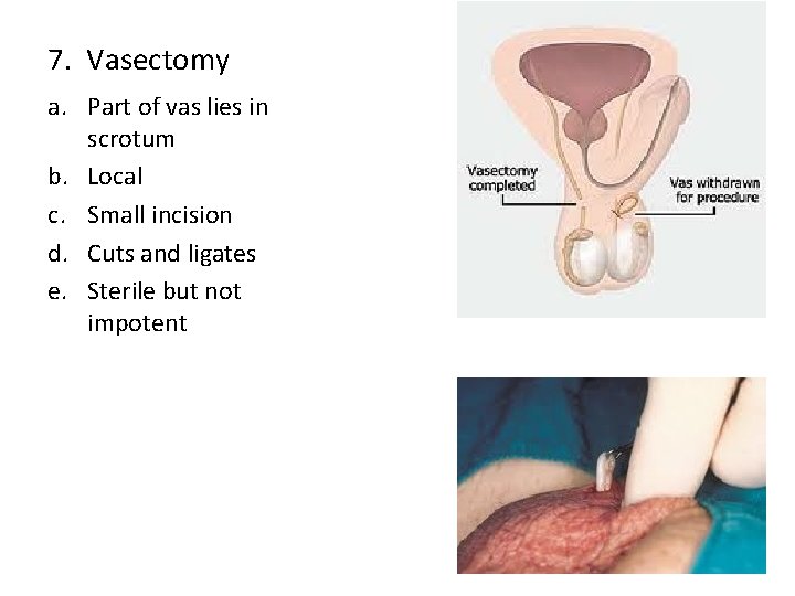 7. Vasectomy a. Part of vas lies in scrotum b. Local c. Small incision