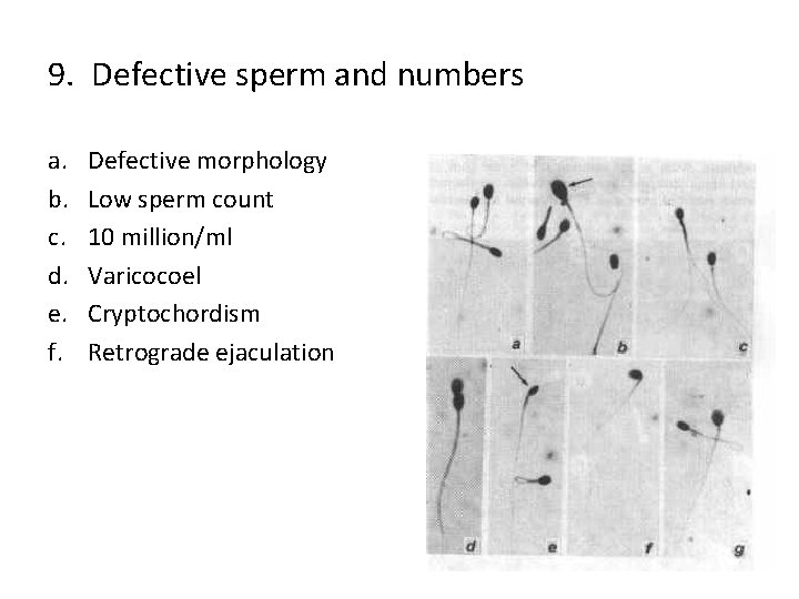 9. Defective sperm and numbers a. b. c. d. e. f. Defective morphology Low