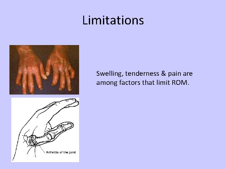 Limitations Swelling, tenderness & pain are among factors that limit ROM. 
