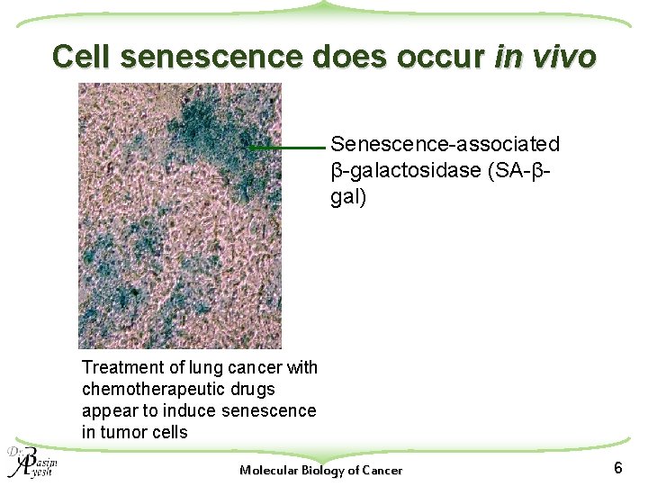 Cell senescence does occur in vivo Senescence-associated β-galactosidase (SA-βgal) Treatment of lung cancer with