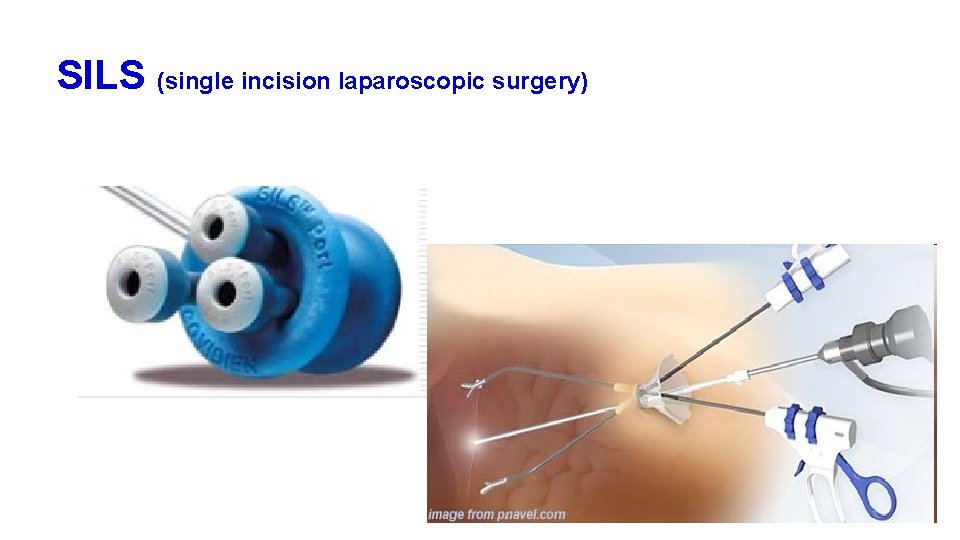 SILS (single incision laparoscopic surgery) 