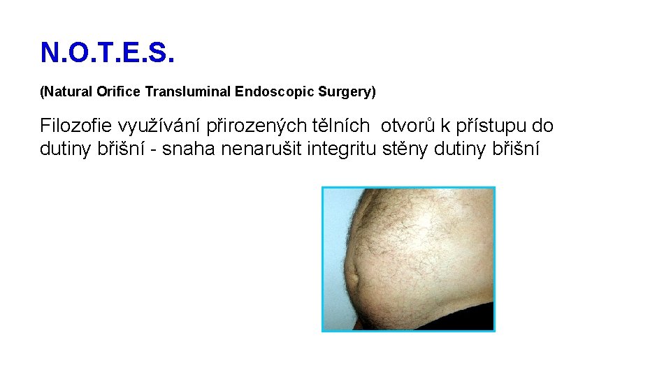 N. O. T. E. S. (Natural Orifice Transluminal Endoscopic Surgery) Filozofie využívání přirozených tělních