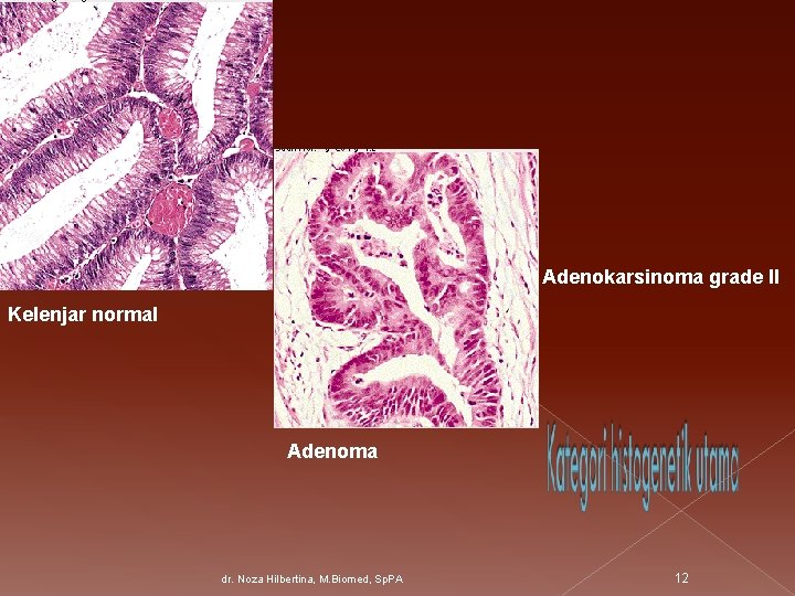 Adenokarsinoma grade II Kelenjar normal Adenoma dr. Noza Hilbertina, M. Biomed, Sp. PA 12