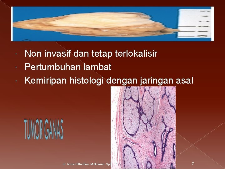 Non invasif dan tetap terlokalisir Pertumbuhan lambat Kemiripan histologi dengan jaringan asal dr. Noza