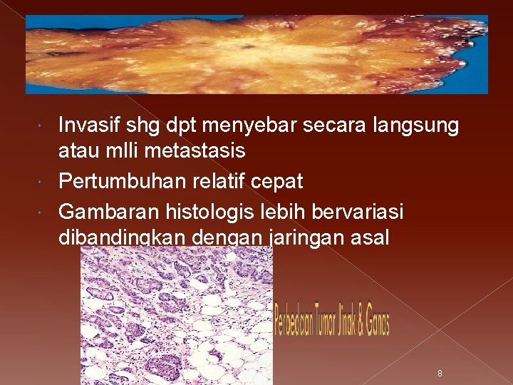 Invasif shg dpt menyebar secara langsung atau mlli metastasis Pertumbuhan relatif cepat Gambaran histologis
