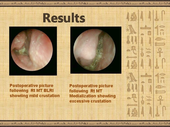 Results Postoperative picture following Rt MT BLRI showiing mild crustation Postoperative picture following Rt