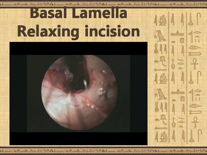 Basal Lamella Relaxing incision 