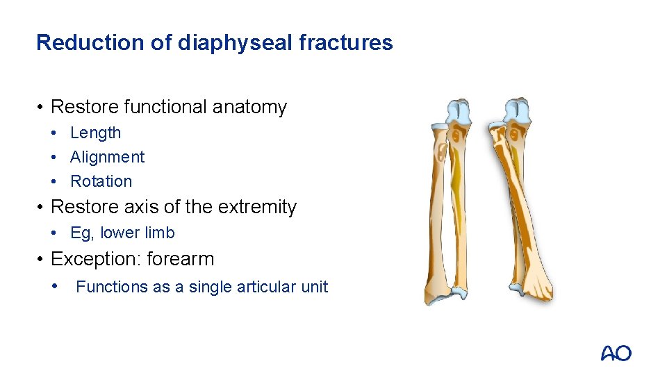 Reduction of diaphyseal fractures • Restore functional anatomy • Length • Alignment • Rotation