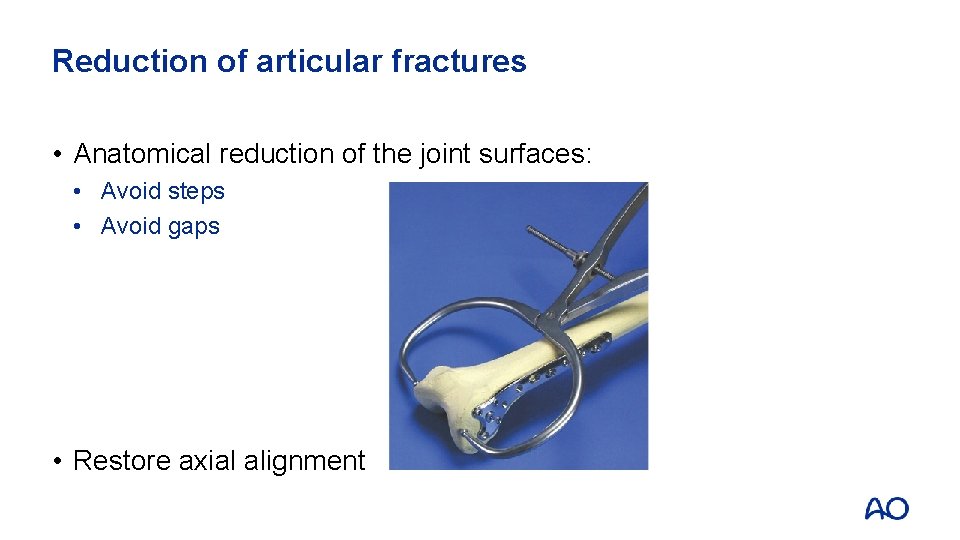 Reduction of articular fractures • Anatomical reduction of the joint surfaces: • Avoid steps