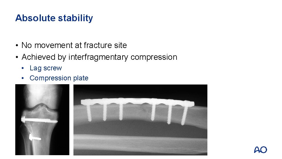 Absolute stability • No movement at fracture site • Achieved by interfragmentary compression •