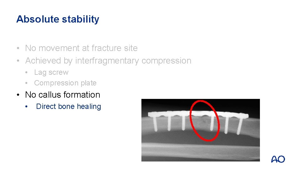 Absolute stability • No movement at fracture site • Achieved by interfragmentary compression •