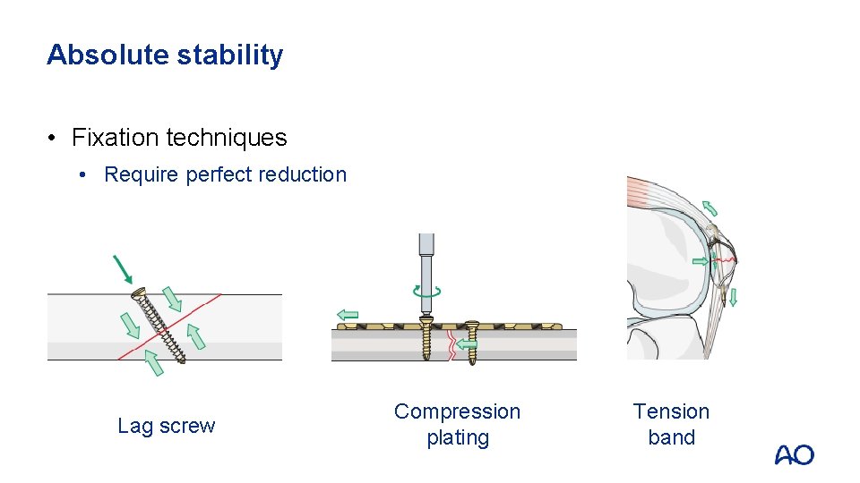 Absolute stability • Fixation techniques • Require perfect reduction Lag screw Compression plating Tension
