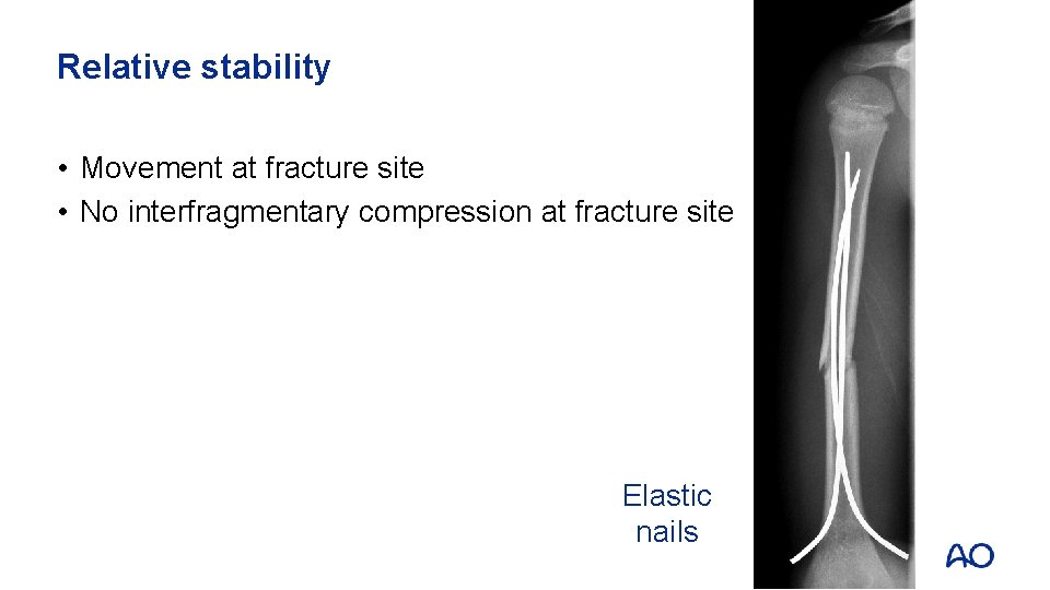 Relative stability • Movement at fracture site • No interfragmentary compression at fracture site