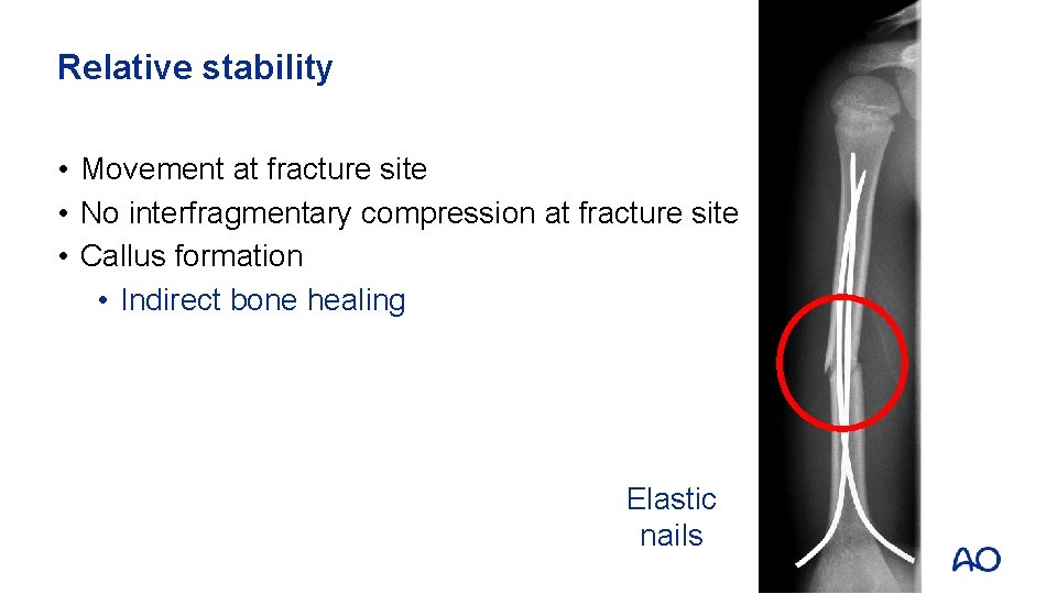 Relative stability • Movement at fracture site • No interfragmentary compression at fracture site